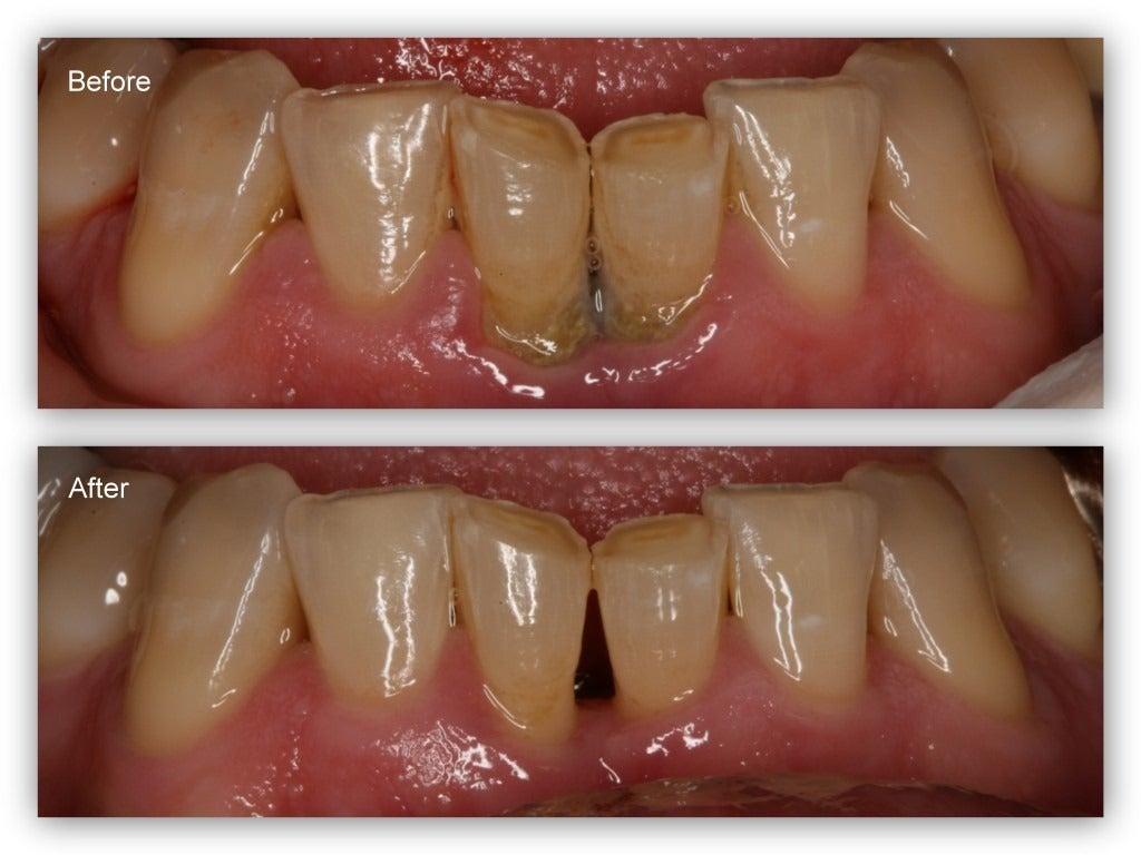 Gum Protect Gel