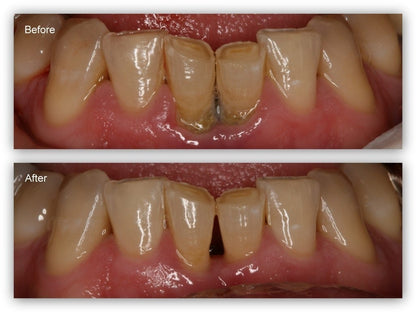 Gum Protect Gel