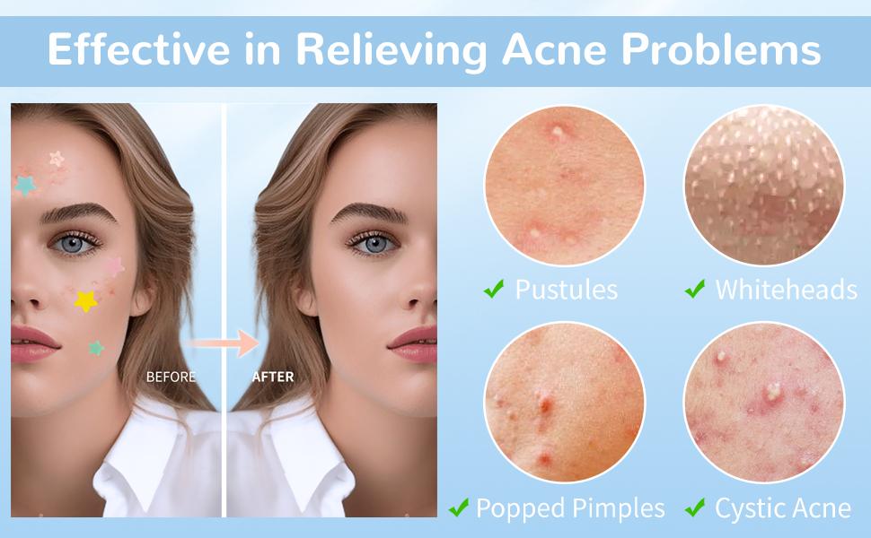 Star Acne Patches